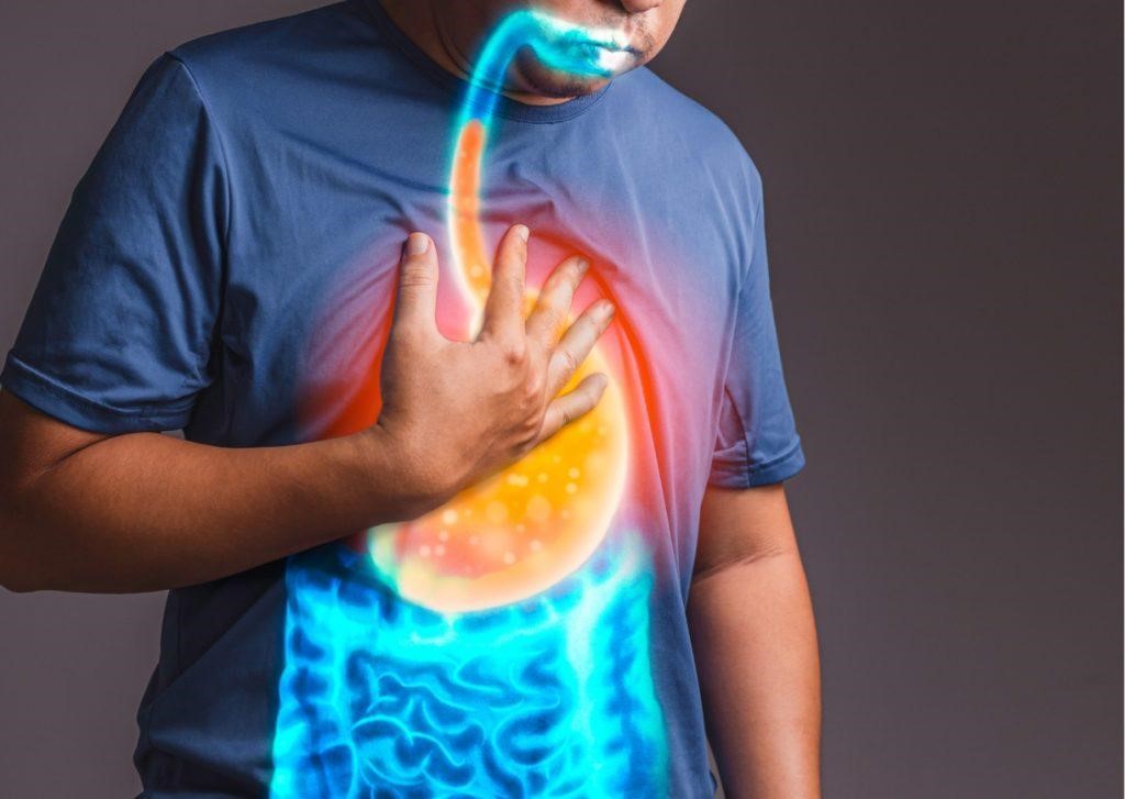 GERD or Gastro Esophageal Reflux Disease